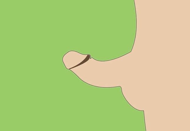 curbura penisului ca indicatie pentru marirea chirurgicala